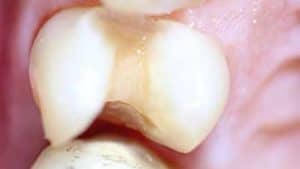 docteur marc chouraki chirurgien dentiste a paris 8 implantologie implantologue 8eme arrondissement inlay ceramique